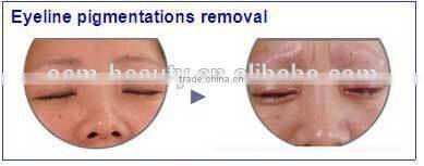 best selling products yag q-switched medical tattoo remove machine with CE certificate D003