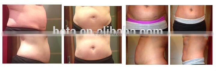 Fat Cavitation Device For Home RF weight Loss Machine