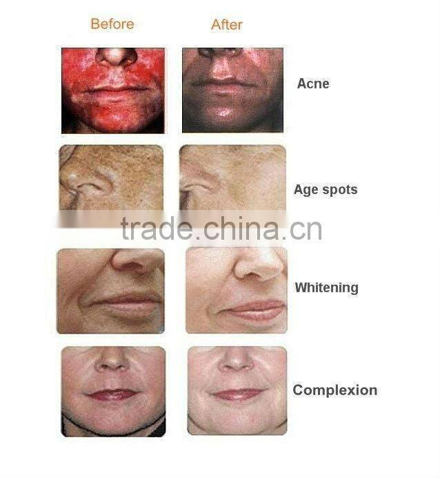 ABS touch screen almighty oxygen jet peel for Skin care with CE approval