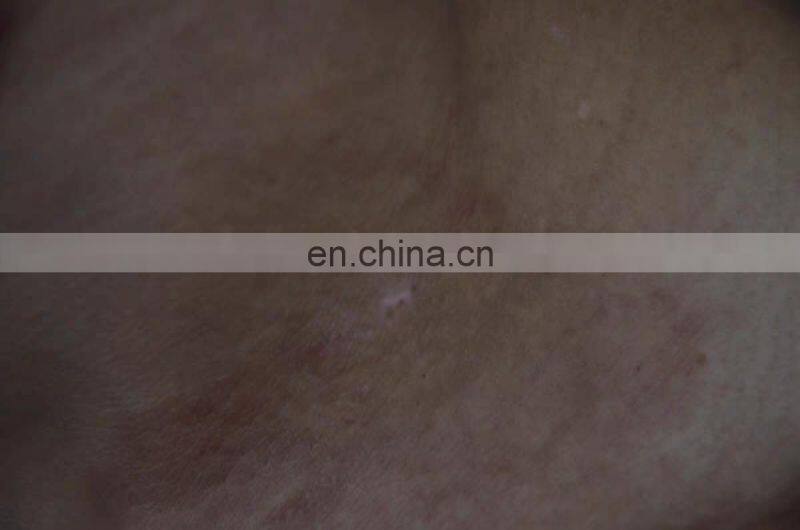 308 nm excimer laser machine fototerapia dermatologia any new puva treatment psoriasis vitiligo light system india price