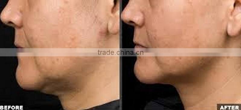 Hot Fractional & Micro needle RF machine for face lifting & skin rejuvenation