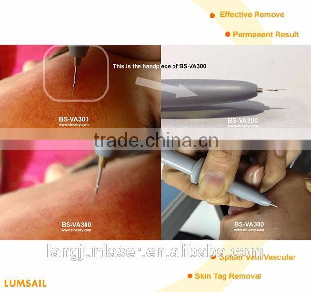 Beautiful Professional Cure Telangiectasia Treatment Vein Removal Equipment