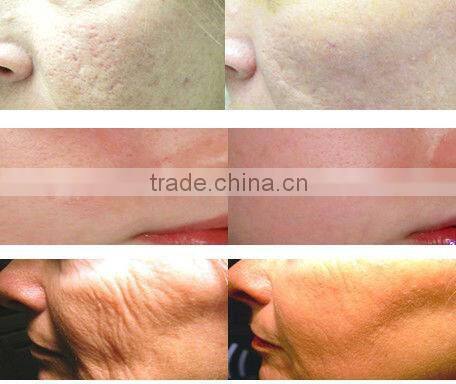 Professional Fractional CO2 Laser RF beauty clinic CE medical ISO