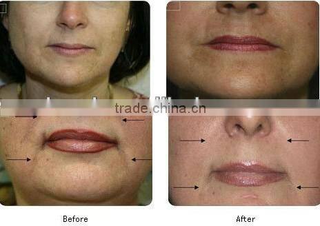 Professional Skin Resurfacing medical fractional co2 laser beauty machine