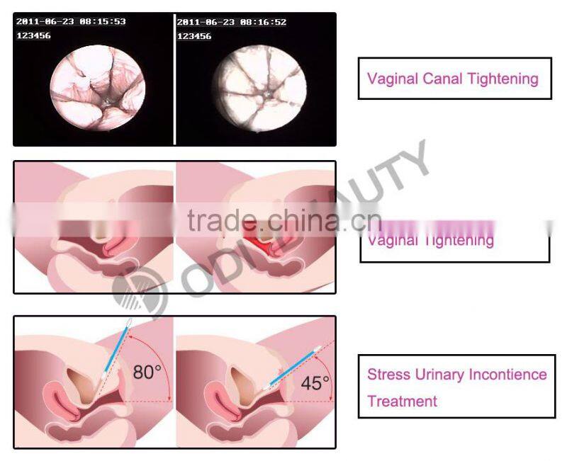 Alibaba express vaginal tightening co2 fraction laser OD-V8