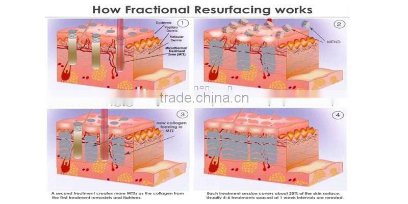 fractional CO2 laser scar removal vaginal tightening facial acne pit removal