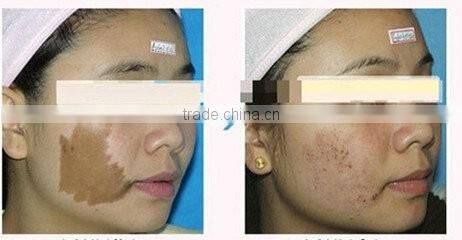 portable Laser spot removal pen/freckle removal pen/mole removal machine for HOT SALE