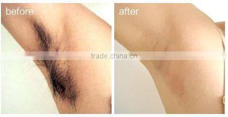 New 808nm diode laser hair removal machine/ hair removal speed 808