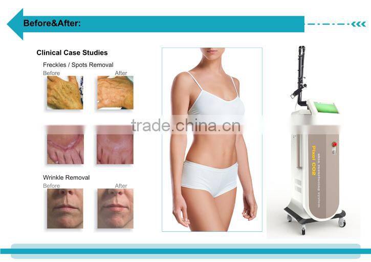 rf tube co2 fractional laser