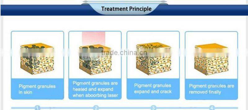 Best laser tattoo removal Q-switch ND-10 YAG laser