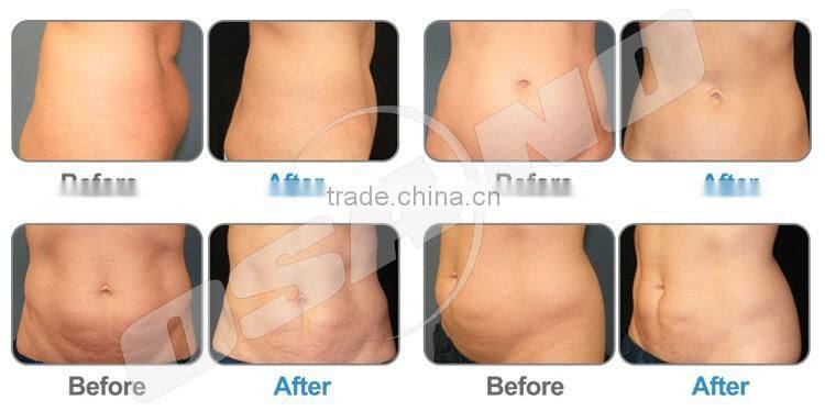Criolipolise slimming / Criolipolisis slimming machine / Criolipolisys fat freezing cryolipolysis