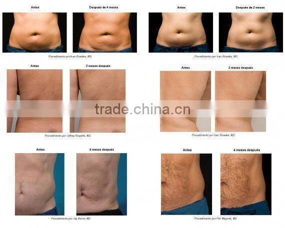 2012 650nm Diode Laser Fat Burning Device CE