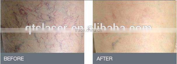 QTS 2016 Blood Vessels spider veins Removal ,with 980nm wavelength laser