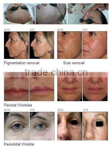 2016 new professional Glass RF pipe 10600nm co2 laser 40w co2 fractional laser beauty device