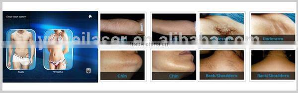 High effective painfree 808nm diode laser hair removal machine
