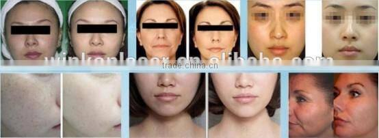 skin care equipment / pdt beauty machine/ men's skin care