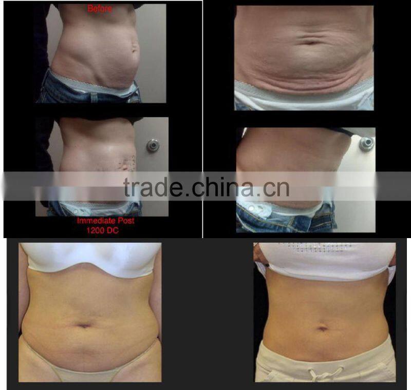 NL-TM804 2016 NEWLIFE skin tighten machine rf fractional thermagic/ rf wrinkle removal thermagic machine