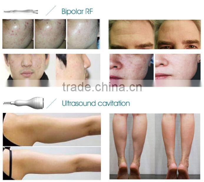 fast slimming Focused ultrasound body slimming system ultrasonic mach cellulite reduce body shaper slimming machine