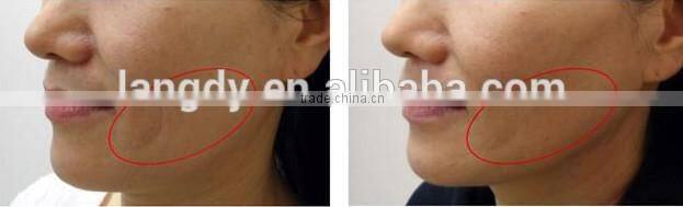 Ultrasound therapy hifu facelift wrinkle removal spa use machine