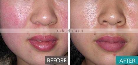 Vascular Removal Laser 980 Machine