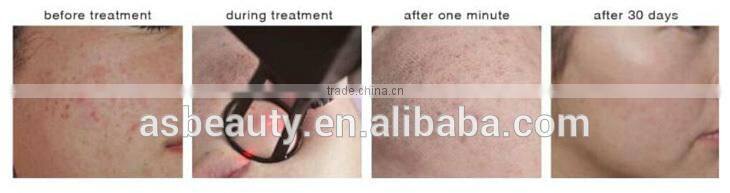 10600nm co2 laser machine/laser co2/home use co2 fractional laser