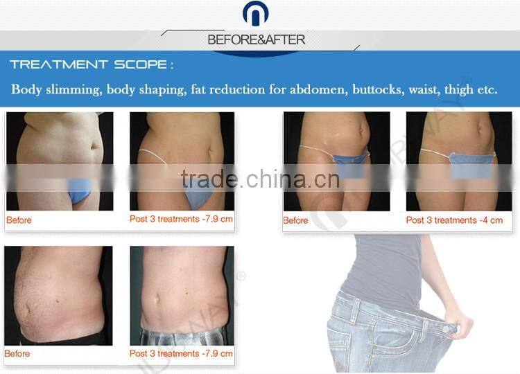 Vertical type HIFU / HIFU slimming machine / cavitation slimming machine