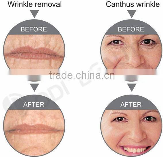 skin tightening beauty machine OD-R105 face lifting portable rf radio frequency facial machine for home use