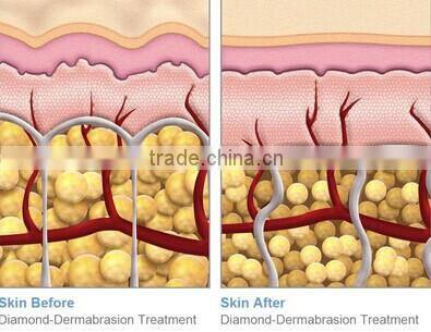 OL-8001B diamond dermabrasion beauty care equipment with cold &hot hammer for skin rejuvenation