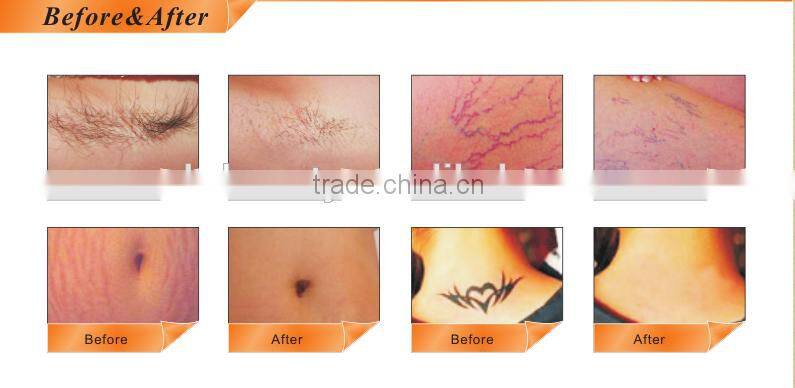 sufficient energy tattoo removal device nd yag laser for Stretch Marks Removal