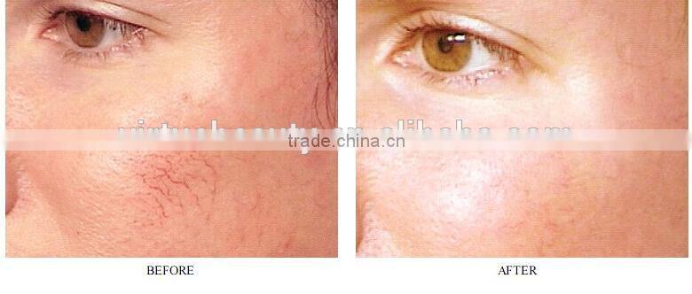 Vertical Multifunctional SHR hair removal machine