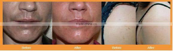 Vertical IPL+ RF hair removal & skin rejuvenation machine MED-130C