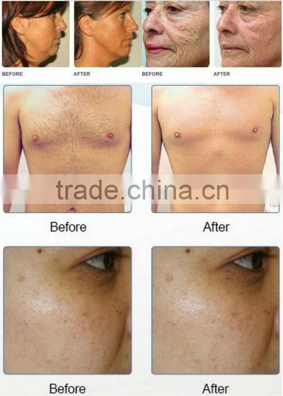 Pain-free Depilation Device hair removal SHR IPL