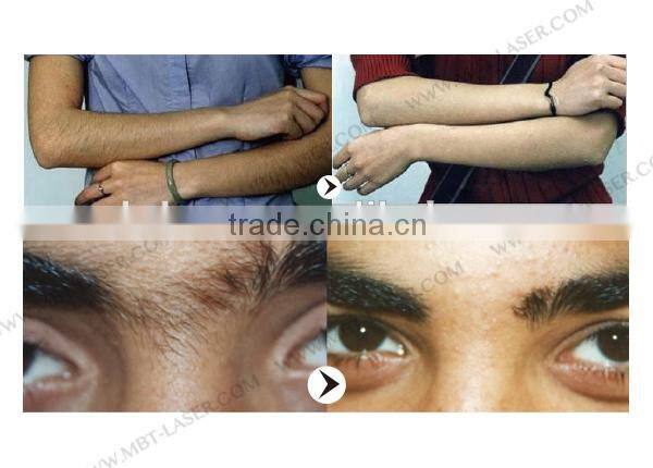 Germany bars portable 808nm diode laser laser hair removal machine for sale