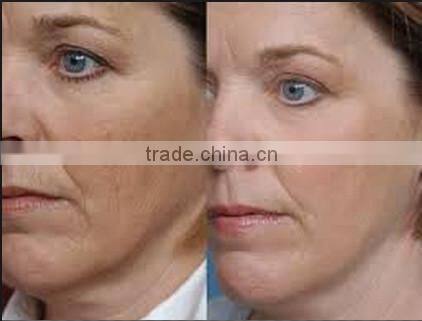 Skin younger face skin rejuvenation machine water oxygen facial
