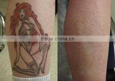 Soft Laser Machine Tattoo Removal Machine with infrared light D006