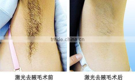 Smart portable ipl shrlaser+Elight+nd yag laser working+CE+forever beauty laser for beauty spa ,hospital ,clinic and salon