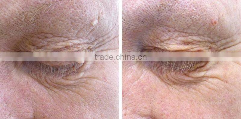 30 MHz Portable Red Vascular Lesion Treatment System Blood Vessels Removal