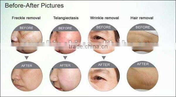 CE approved soprano diode laser skin hair removal ipl machine with big spot size! (150000 shots,low price)