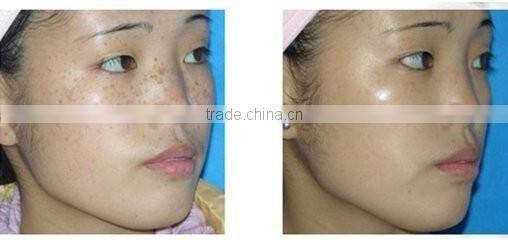 portable Laser spot removal pen/freckle removal pen/mole removal machine for HOT SALE