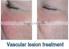 Health Care Beauty Equipment ipl rf filter 430 nd yag laser hair removal machin