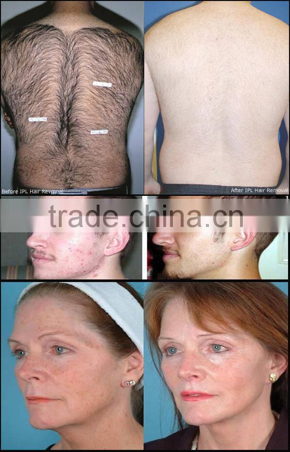 Intense pulsed light acne removal blue light therapy for acne