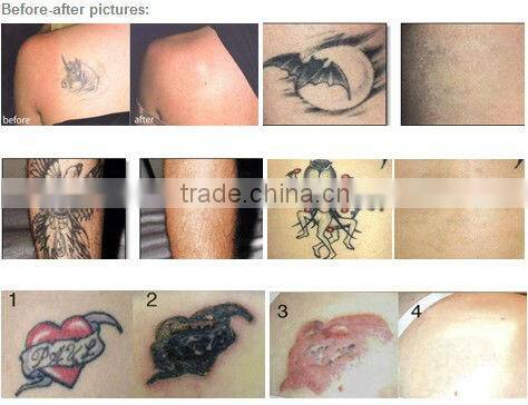 2014 Hottest sale q-switched nd yag laser tattoo removal machine nd yag laser korea