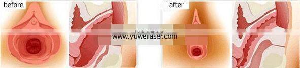 2016 hotselling! fractional CO2 vaginal rejuvenation laser machine