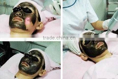 Raynol Beijing China Supplier Beauty Salon and Clinic Used Q Switched Nd:YAG Laser Therapy Eyebrow Tattoo Removal