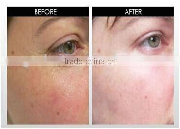 180 Eye Wrinkles Needle Roller Acne Scars Cellulite Stretch Mark Face Body Derma