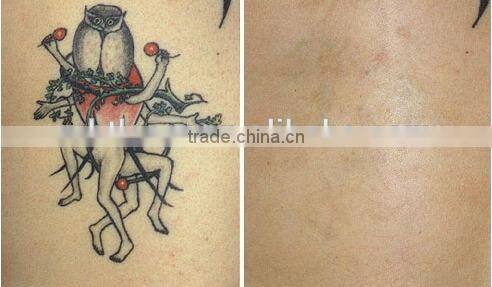 New hot professional type nd yag :laser tatoo remover and freckles remove with CE and GOST-P