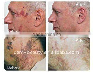 666 Good quality portable tattoo removal Q switch nd yag laser equipment for pigment removal and skin toning