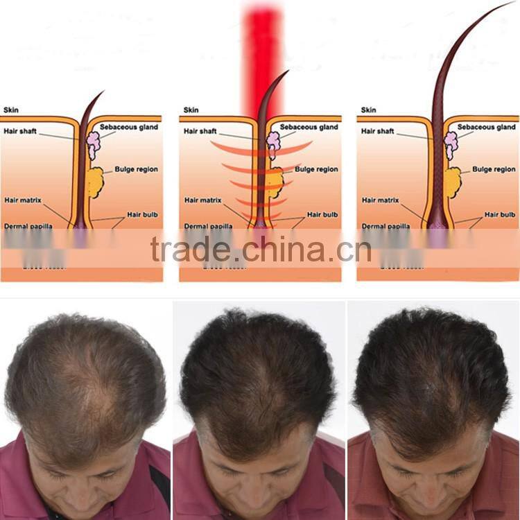 CE ISO Low Level Laser Therapy Hair Loss Treatment / China Hair Loss Treatment Beauty Device