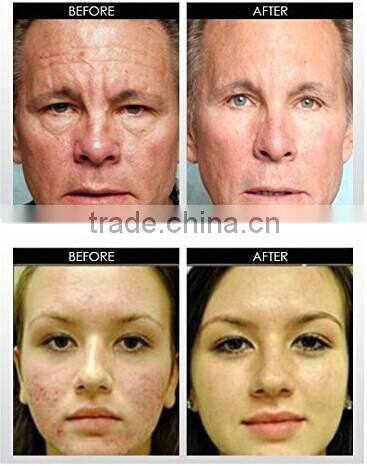 scar removal derma roller with changeable heads 1200 needles beauty roller