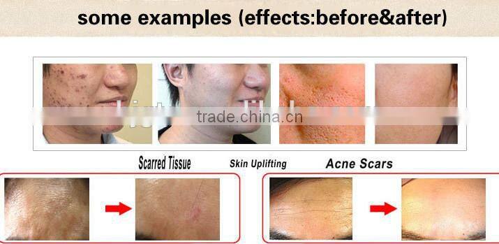 wholesale manufacture GTO microneedle 540 derma roller